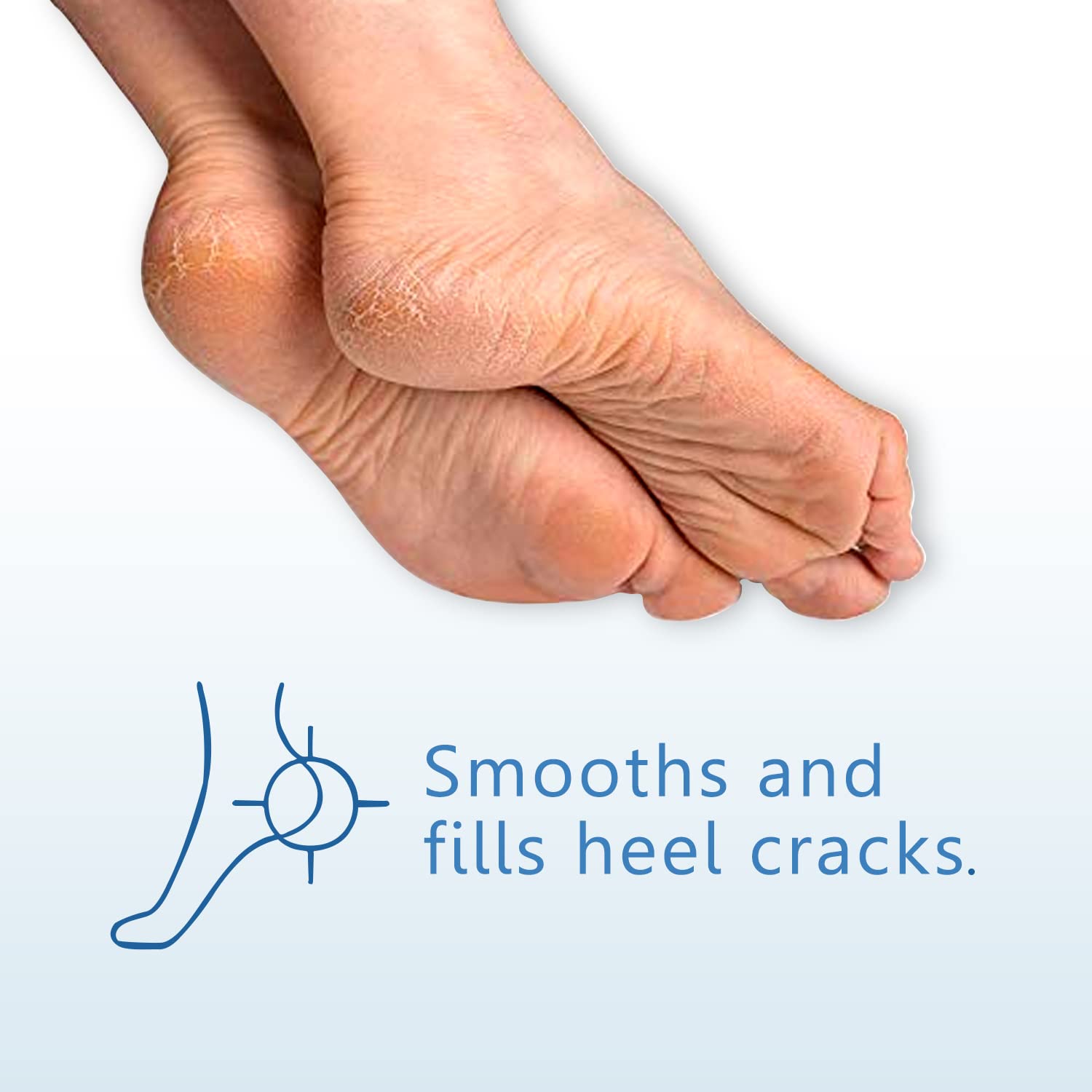 Cracked Heels - Causes, Symptoms and Natural Healing Methods